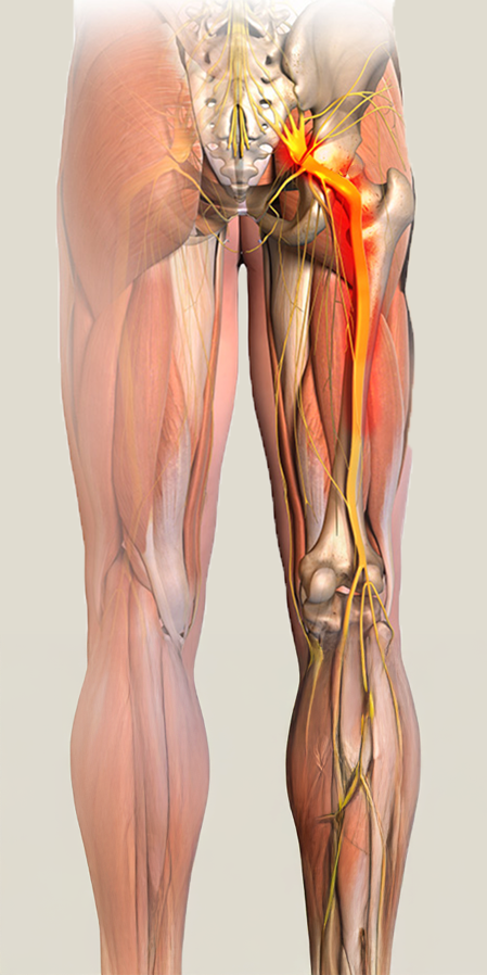 Alaselkäkipu ja iskias 2 ischias oireet